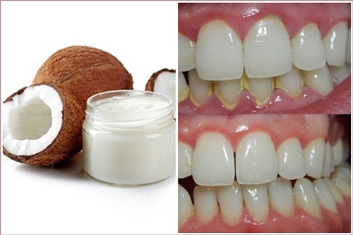 cách lấy cao răng bằng dầu dừa