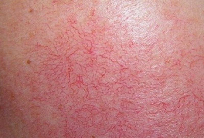 Làn da bị giãn mao mạch, mỏng yếu sau khi sử dụng các sản phẩm tắm trắng tẩy lột mạnh, chứa corticoid